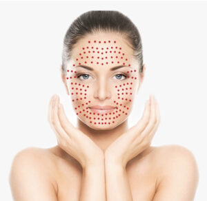 PRP Facial Treatments by Aesthetics by Phoebe at Beauty Believable