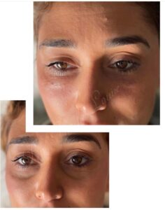 AESTHETICS BY PHOEBE ANTI WRINKLE CONSULTATIONS, LIP FILLER & PRP FACIALS at Beauty Believable Bishops Stortford